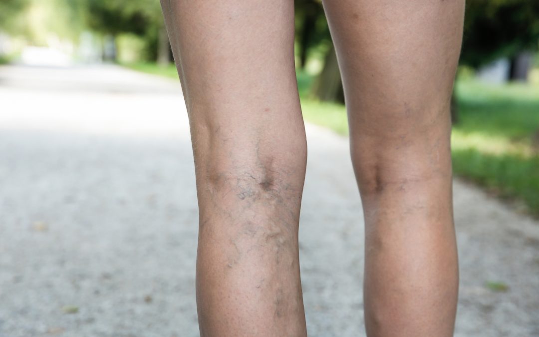 A Homeopathic Medicine Approach for Varicose Veins